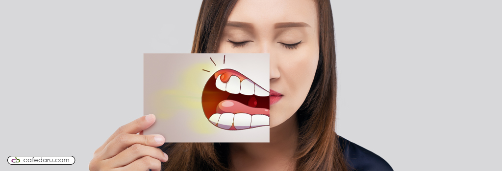 آفت دهان و نحوه درمان آن